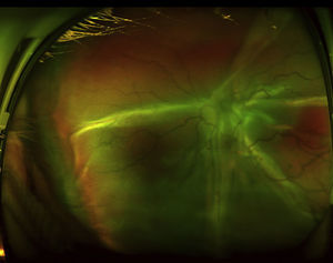 Fotografía de campo ultra-amplio en un ojo derecho obtenida con un Optos Daytona (Optos, Dunfermline, Reino Unido), que muestra un desprendimiento de retina total secundario a un síndrome de efusión uveal en un ojo nanoftálmico. La extensión del desprendimiento es tal que no se observa la papila ni el nervio óptico.