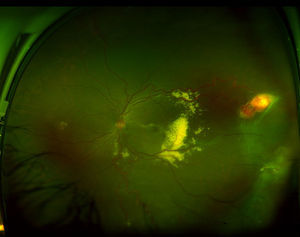 Fotografía de campo ultra-amplio en un ojo izquierdo obtenida con un Optos Daytona (Optos, Dunfermline, Reino Unido), que muestra un caso de enfermedad de Von Hippel. Se puede observar exudación importante en la zona macular, y la presencia de un hemangioblastoma en la periferia temporal.