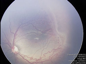 Fotografía obtenida con una RetCam II (Clarity Medical Systems, California, EE. UU.) en el ojo de un bebé prematuro, que muestra retinopatía del prematuro estadio 2 en zona i. Este sistema de contacto permite una visualización de 120 grados del fondo.