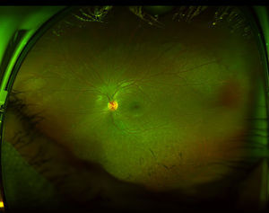 Fotografía de campo ultra-amplio en un ojo izquierdo obtenida con un Optos Daytona (Optos, Dunfermline, Reino Unido) que muestra datos compatibles con retinitis pigmentosa sectorial. Se observa una acumulación de pigmento en una configuración que semeja espículas óseas, confinada a la retina inferior, mientras que el resto de la retina no se encuentra afectada.