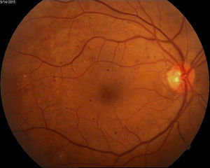 Ejemplo de retinopatía diabética con características de alto riesgo.