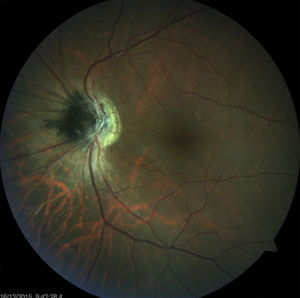 Fundus photograph showing an optic disk melanocytoma.