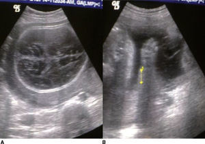 Cráneo que se deprime a la presión con transductor (A). Huesos largos 6 semanas más cortos en relación con la edad gestacional (B). Micromelia de miembros.
