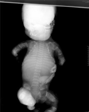 Radiografía anteroposterior que muestra macrocráneo, tórax estrecho, costillas cortas, hipoplasia de huesos pélvicos, fémur recto, micromelia de las cuatro extremidades y la forma característica de los cuerpos vertebrales (“U” invertida).