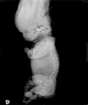Radiografía lateral que muestra la platispondilia, más marcada en la región lumbar. Se observa la protrusión de los huesos frontales y el acortamiento de las cuatro extremidades.