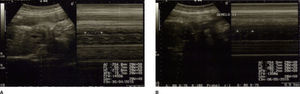 Imágenes ultrasonograficas no especificas para el diagnostico correspondiente a siameses toracopagos. A: Cavidad cardiaca GI. B: Cavidad cardiaca GII.
