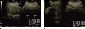 Imágenes no concluyentes de ambos abdómenes. A: Circunferencia abdominal no delimitada GI. B: Circunferencia abdominal no delimitada GII.
