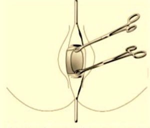 Placing of straight Foerster forceps at the anterior and posterior labia of cervix.