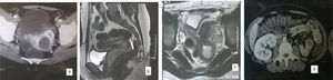 Computerized tomography (CT) revealed vaginal cystic mass with bicoruate uterus (a), magnetic resonance imaging with uterine cavity communicating with the cystic mass in vagina with bicornuate uterus (b,c), CT revealing hydronephrotic right kidney with absent left one (d).