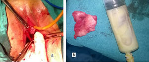 After incision the septum with duplicate vagina (a), excised longitudinal vaginal septum and pus from aspiration (b).