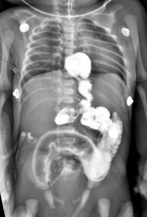 Estudio de contraste mostrando signos de malrotación intestinal, tales como intestino delgado vertical después de lo que parece ser el estómago (intratorácico) y ciego localizado en el lado izquierdo.