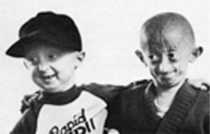 Niños con progeria infantil, cuando todavia no cumplían los 10 anos de edad (tomada de Starr y Taggart, 2008).