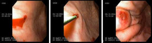 Lesión de Dieulafoy: sangrado activo babeante (IB), sometida a método de inyección.