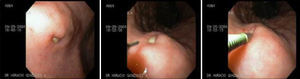 Lesión de Dieulafoy: nueva intervención endoscópica con método de inyección.