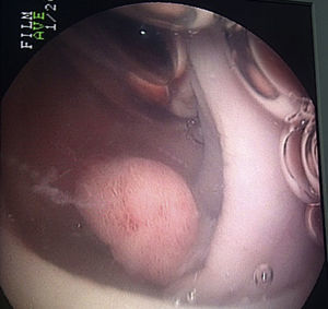 Lesión 0-lp colonoscopia con técnica de inmersión.