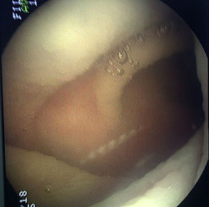 Colonoscopia con técnica de inmersión.