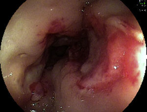 Imagen endoscópica de esófago (tercio inferior).