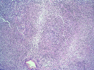 Imagen histopatólogica de esófago. Tinción H-E, se observa infiltrado linfocitario difuso.