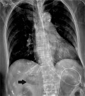 Radiografía de tórax que demuestra neumobilia (flecha).