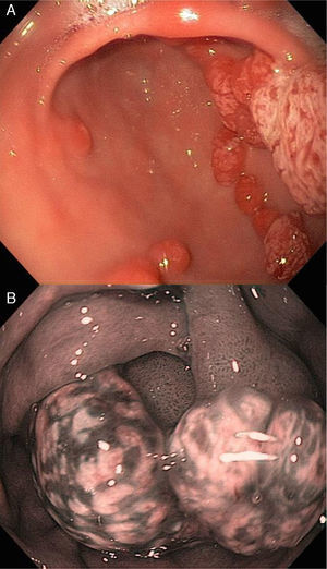 A y B)Pólipos hiperplásicos en el estómago. Visión endoscópica con luz blanca y NBI.
