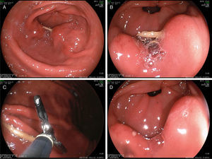 A-B) Cuerpo extraño (mondadientes) impactado en mucosa antral. C) Extracción con pinza de cuerpo extraño. D) Dos úlceras de 4mm secundarias a cuerpo extraño.