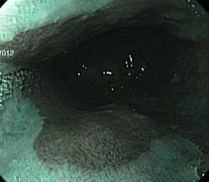 Esófago de Barret. Imagen endoscópica con NBI.