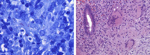 (a) Ziehl–Nielsen stain that shows numerous acid-fast bacilli (100×). (b) Hematoxiline-Eosine stain with granulomatous colitis with Langhans giant cells (20×).