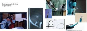 Sistemas de colangioscopia de 2 operadores y Spy Glass®.