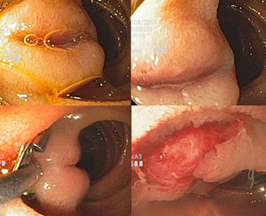 Lesión localizada en yeyuno, firme, con ulceración superficial. Se tomó biopsia utilizando técnica de biopsia sobre biopsia.