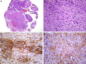 La mucosa yeyunal mostro una neoplasia mesenquimal subepitelial benigna (a). El tumor estaba compuesto de células fusiformes con atipia leve y citoplasma vacuolado (b). Las células neoplásicas fueron CD34 positivo (c). Las células neoplásicas fueron CD117 positivo. Además, fue positivo para DOG.1 (no mostrado) (d).