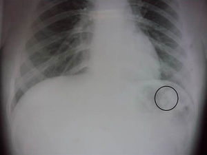 Radiografía posteroanterior de tórax; se observan cerdas de cepillo de dientes en estómago.