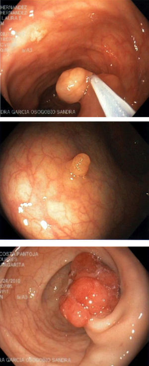 Polyps found during colonoscopies and snare polypectomy.