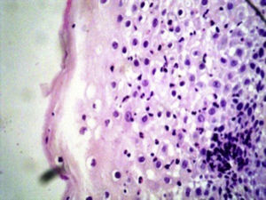 Microfotografía de mucosa esofágica con intenso infiltrado inflamatorio representado por polimorfonucleares que se distribuyen en pequeños grupos y en forma aislada en todo el epitelio.