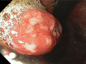 Pólipo hiperplásico con superficie despulida y fibrina.