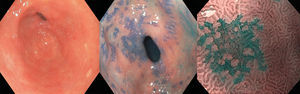 Metaplasia gástrica vista con luz convencional, azul de metileno y NBI con magnificación. Imágenes cortesía del Dr. Barreto.