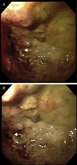 A y 1B. Colonoscopia en la que se observa un tumor en recto, con pérdida de la anatomía y oclusión de más del 90% de la luz. La fecha indica el sitio de la luz intestinal.