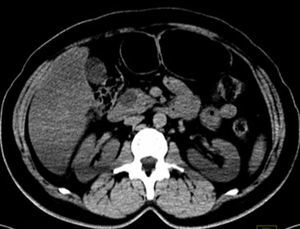 CT scan with hypodense cystic lesion located in the head and uncinate process of the pancreas that measures 20×11mm.
