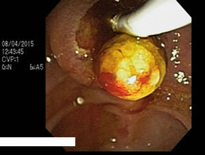 ERCP obtaining one yellow round bile duct stone of 5mm of diameter.