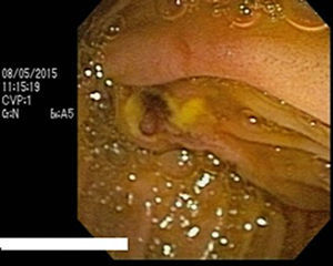 Upper endoscopy with duodenoscope without evidence of bleeding from sphyncterotomy.
