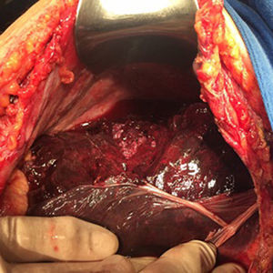 Rupture of Glisson's capsule observed in laparotomy.