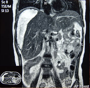 Subcapsular hepatic hematoma of 15.2×10.4×3.6cm in the right hepatic lobe in magnetic resonance imaging (MRI) one month after presentationT2W sequence on a 1.5-T MRI machine.