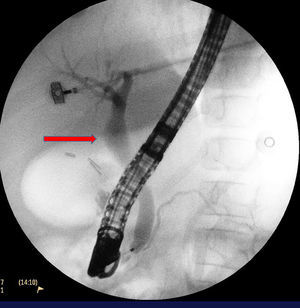 Imagen de colangiopancreatografía retrógrada endoscópica (CPRE) en fase de llenado, se observa implantación alta del Wirsung, dilatación del colédoco supraduodenal, formación de un anillo en el hepático común. Diámetro máximo de 16mm en colédoco superior.
