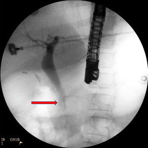 Imagen de colangiopancreatografía retrógrada endoscópica (CPRE) en fase de vaciamiento, se corrobora la implantación alta del Wirsung, colédoco dilatado y la formación de anillo en el hepático común.