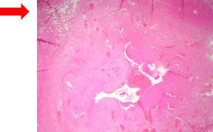 Se observa pared de quiste de colédoco con considerable aumento del espesor, fibrosis y proliferación vascular.