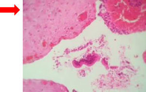Se observa superficie interna del quiste de colédoco con infiltrado inflamatorio de tipo crónico y epitelio desfacelado.