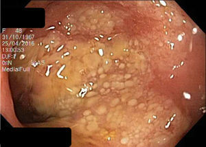 Rectosigmoides que evidencia zonas de mucosa erosionada, placas de fibrina amarillentas y aspecto seudomembranoso.