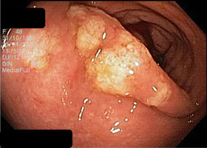 Rectosigmoides que evidencia zonas de mucosa erosionada, placas de fibrina amarillentas y aspecto seudomembranoso.