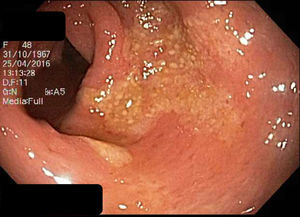Rectosigmoides que evidencia zonas de mucosa erosionada, placas de fibrina amarillentas y aspecto seudomembranoso.