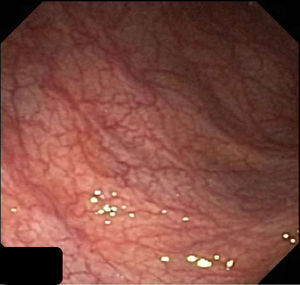 Mucosa colónica friable, de aspecto cicatricial, despulida y con pérdida del patrón haustral normal.