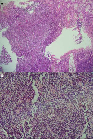 A) Biopsia de ciego con la mucosa infiltrada por una neoplasia linfoide de célula pequeña y núcleos irregulares, que se dispone en un patrón de aspecto difuso con escasos folículos residuales y expansión de la zona del manto. B) Imagen magnificada.